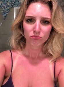 Pictured: what happens when ethnic Norwegians neglect sunscreen.